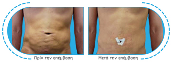 ,, ,vibro lipo,o  , , 