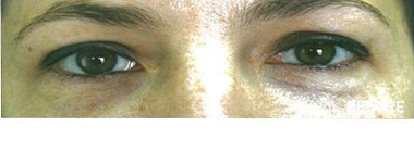 RRS skin eyes_prin meta